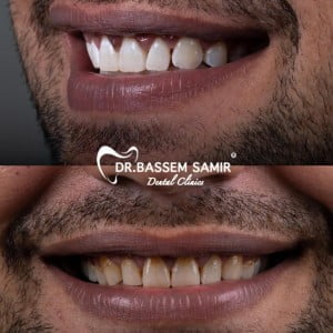 تبييض الأسنان بالليزر قبل وبعد