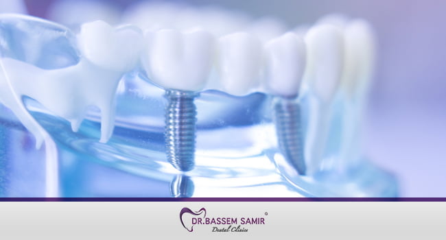 تجربتي مع زراعة الاسنان بالصور 1 مراحل زراعة الأسنان بالصور