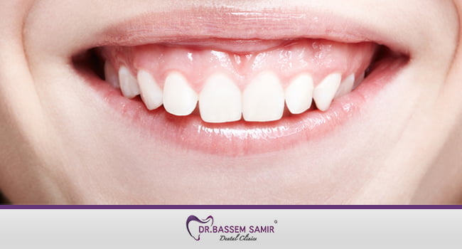 علاج الابتسامة اللثوية بالليزر