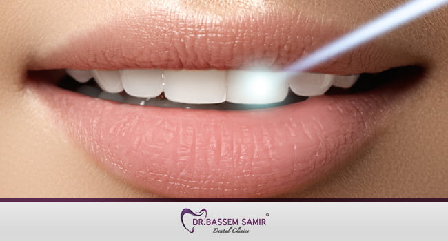 تبييض الاسنان بالليزر