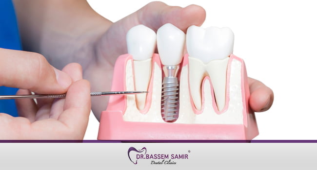 زراعة الاسنان بدون الم وفى جلسة واحدة