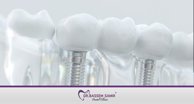 زراعة الاسنان بدون الم