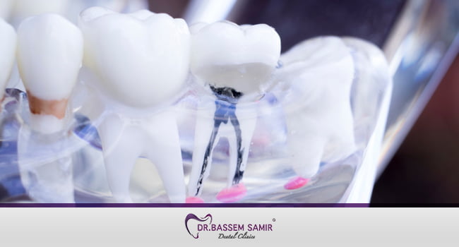 حشو عصب الاسنان - شكل الضرس بعد حشو العصب