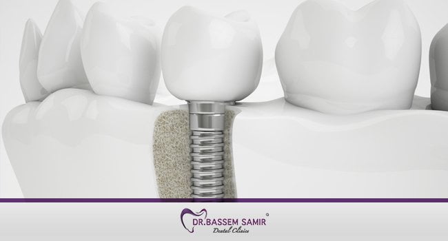 زراعة الاسنان