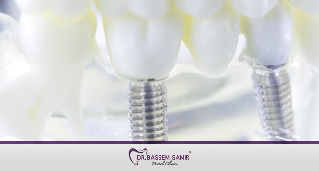 فوائد زراعة الاسنان