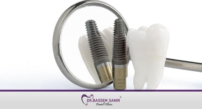 كيفية زراعة الاسنان