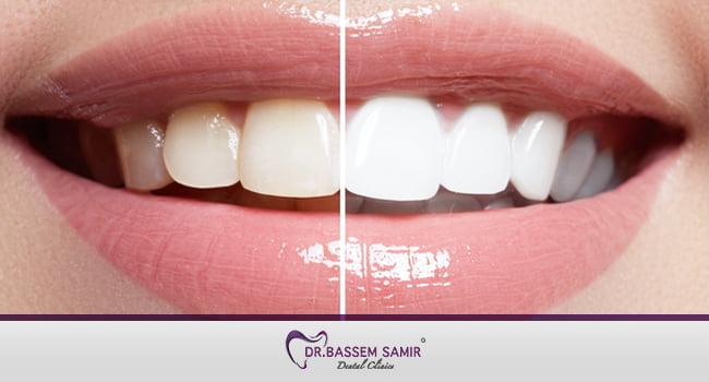 افضل طرق تبييض الاسنان - تبييض الاسنان عند الطبيب