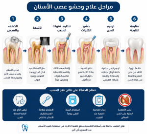 مخطط مراحل علاج وحشو عصب الاسنان