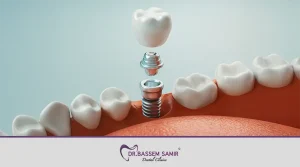 مقالات طبية 9 فوائد زراعة الاسنان