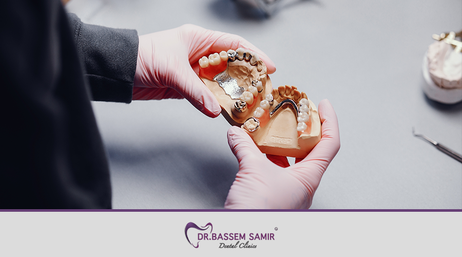 افضل نوع زراعة الاسنان