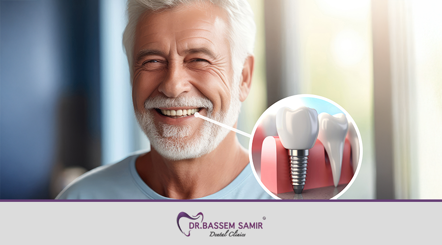 ايهما افضل زراعة الاسنان او الجسر