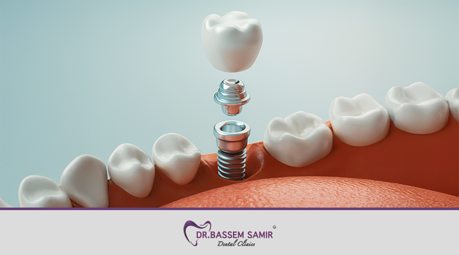 فوائد زراعة الاسنان